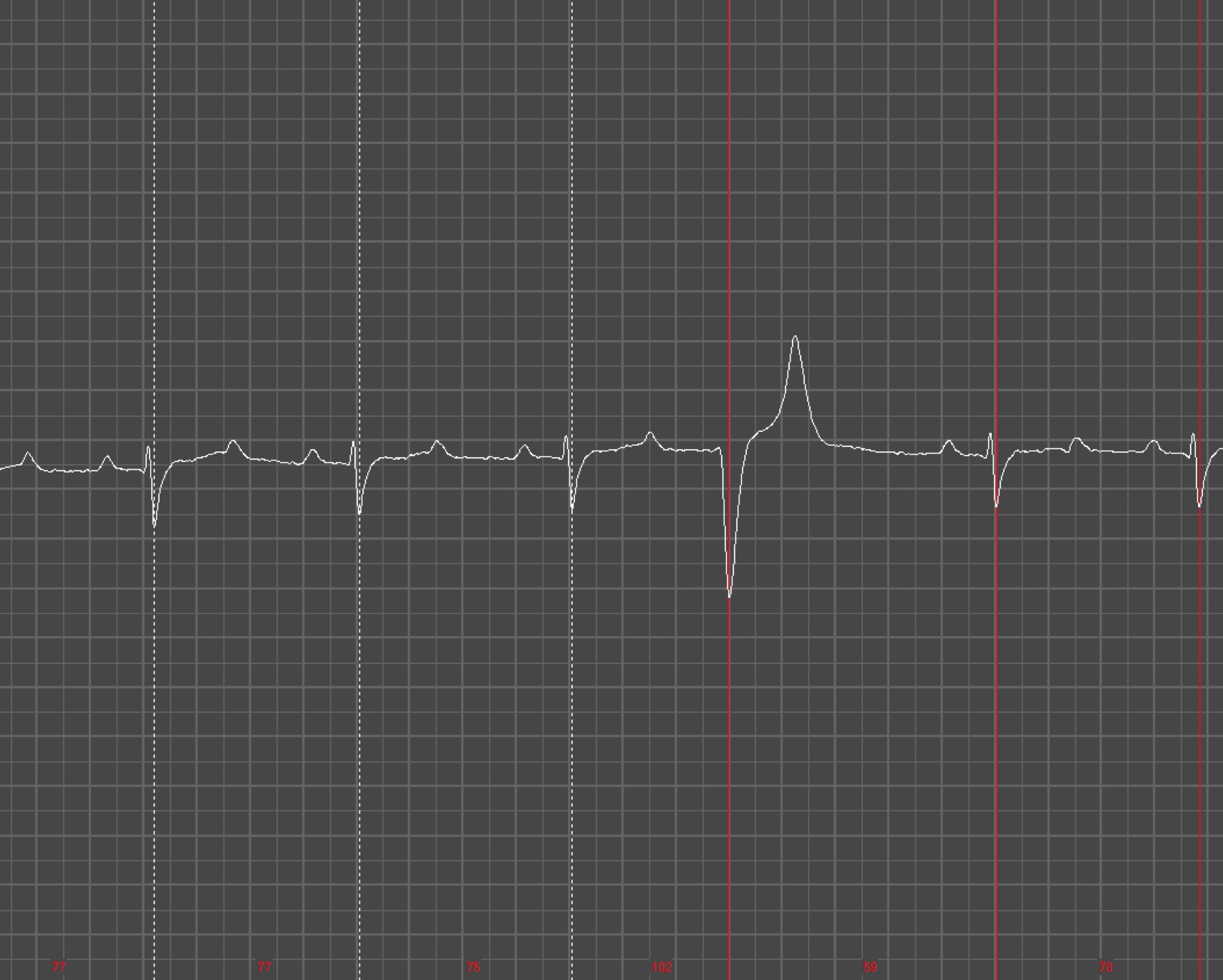 Électrocardiogramme cardio iStock 1174503458 copie